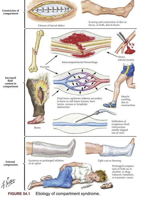 Here are the 17 “Ps” of compartment syndrome: 1. Poikilothermia 2 ...