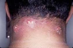 Image result for Removing Carbuncle