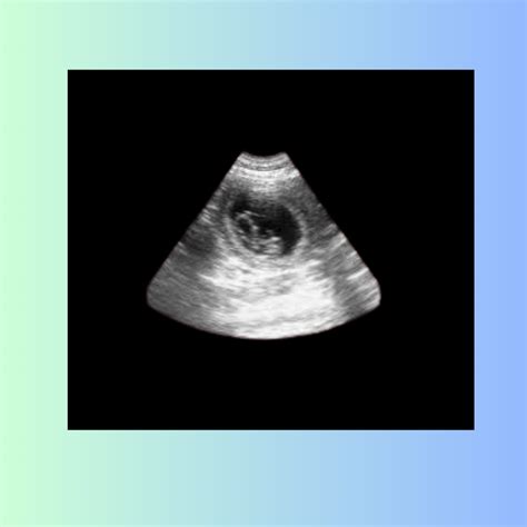 Early Pregnancy Ultrasound 7 Weeks