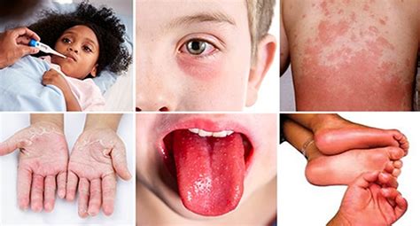 Management of Multisystem Inflammatory Syndrome in Children (MIS-C ...