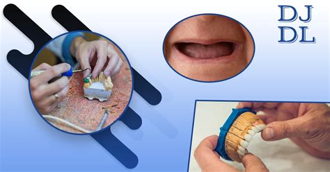 Image result for Immediate Denture Process