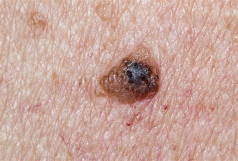 Melanoma Black Spots On Vag Lips Pictures | Lipstutorial.org