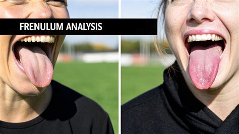 Tongue Tie vs Normal Adults: A Fresh Perspective on Living with Ankyloglossia – myohab - ankyloglossia vs normal tongue