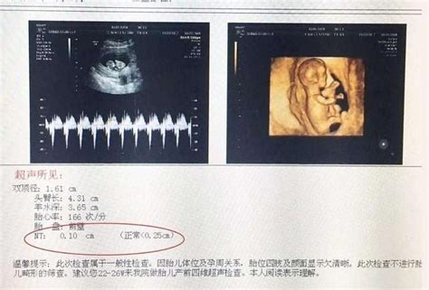 怀孕12周的孕期检查就是NT检查，NT是什么？