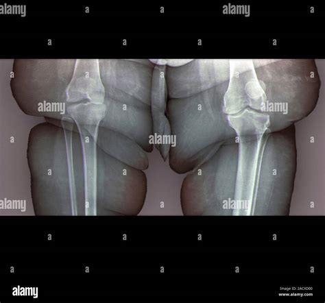 Coloured x-ray of both knees (frontal view) of an obese 23 year-old ...