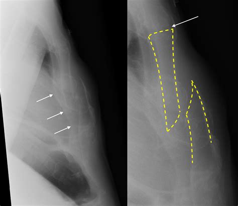 Sternum Fracture X Ray at Martha Suggs blog