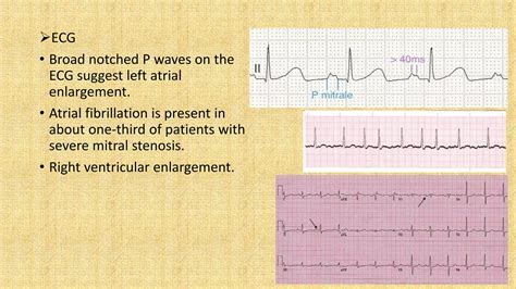 Mitral Stenosis and Anaesthetic Management | PPTX