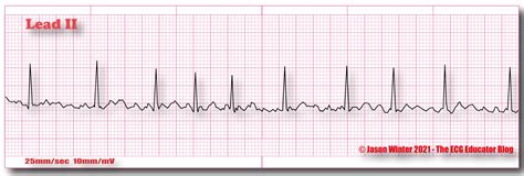 ECG Educator Blog : Atrial Fibrillation (AF)