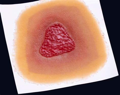 Stage 2 Pressure Injury – Techline Trauma