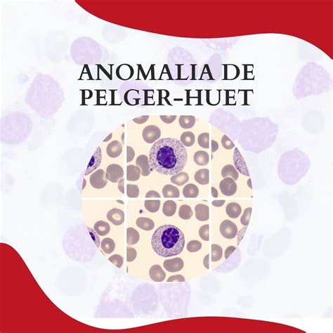 Anomalia De Pelger Huet - RETOEDU