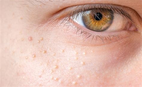 गंदा कॉलेस्ट्रोल बढ़ने से चेहरे पर नजर आ सकते हैं ये 5 लक्षण, समय रहते ...