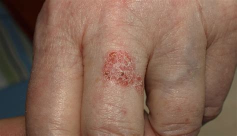 10 Signs and Symptoms of Skin Cancer - lifeberrys.com