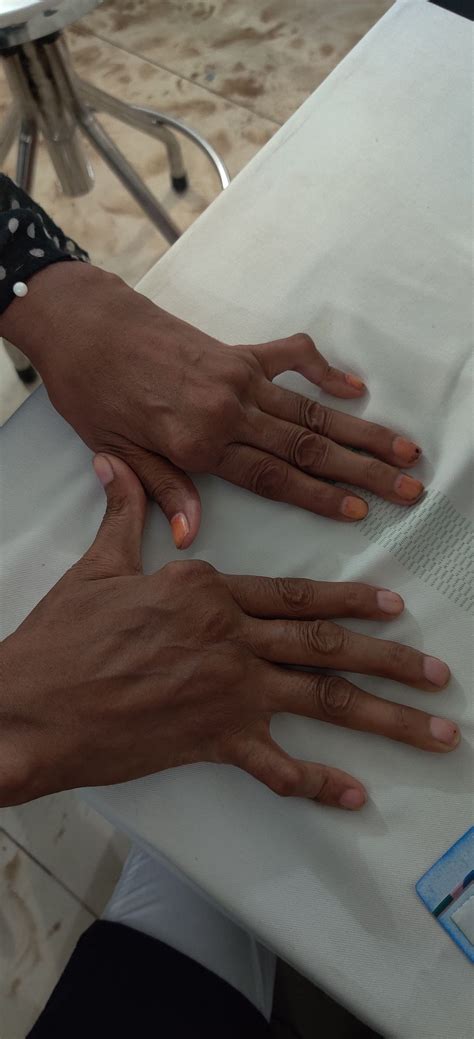 Image result for Hand Dysfunction