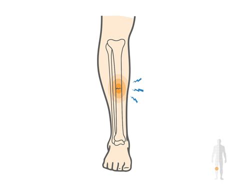 Running Stress Fracture Shin Symptoms