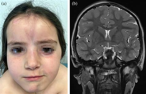 Parry Romberg Syndrome