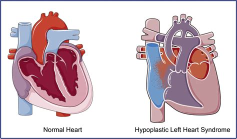 Hypoplastic left heart syndrome: From bedside to bench and back - Journal of Molecular and ...