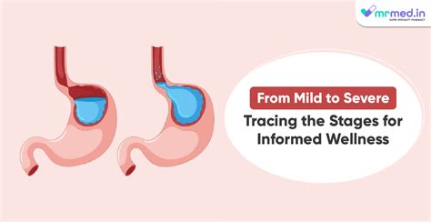 Stage-by-Stage Overview of GERD: Symptoms, Risks, and Solutions