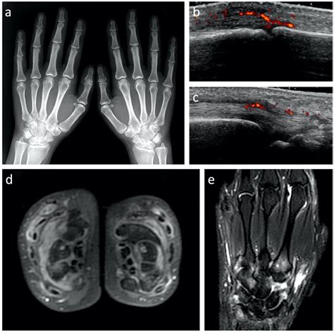 Rheumatoid Arthritis Hand X Ray