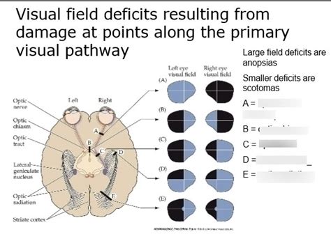 Image result for Visual Deficit Chart