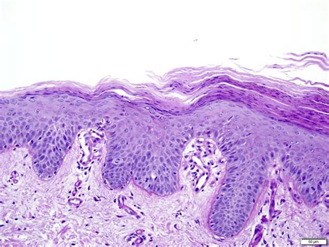 Pathology Outlines - Pityriasis rubra pilaris