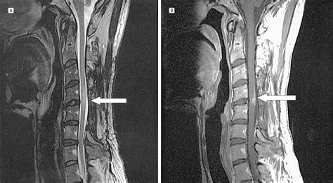 Spinal Neurosarcoidosis Mimicking an Idiopathic Inflammatory Demyelinating Syndrome ...