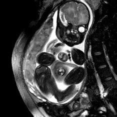 Baby Born With Heart Outside Of Body (Ectopia Cordis) Makes History ...