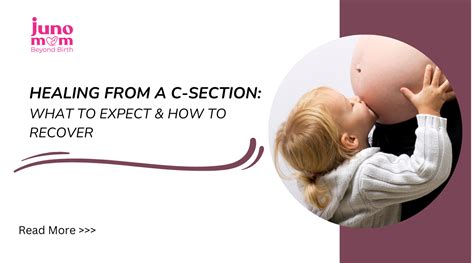 Healing From a C-Section: What To Expect & How To Recover – Juno Mom ...