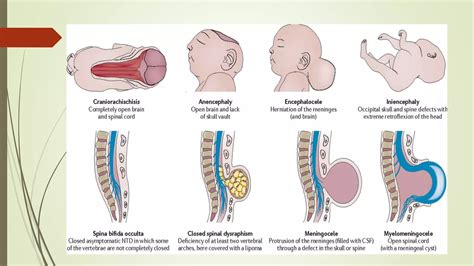 Image result for Neural Tube Defects Causes