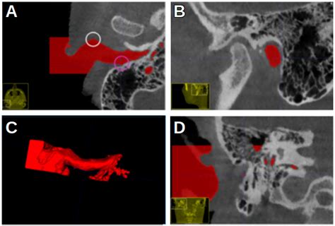 The Reproducibility of Reference Landmarks in the External Acoustic ...