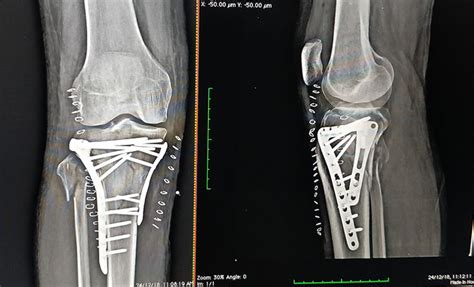 Tibial Plateau Fracture Fixation