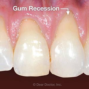 Tooth Recession 的图像结果