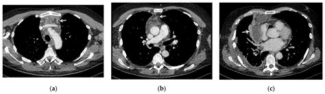 Multidisciplinary Approach in the Treatment of Descending Necrotizing ...