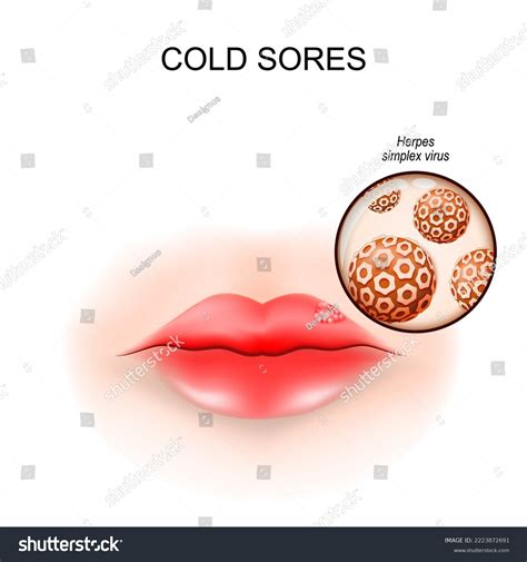 Cold Sores Lip Fever Blisters Closeup: vetor stock (livre de direitos) 2223872691 | Shutterstock
