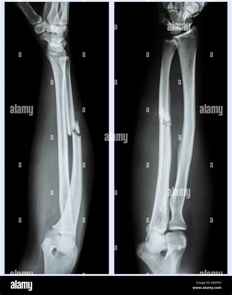 Impacted Bone Fractures