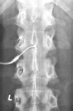 Image result for Myelogram Injection