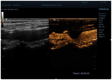 New Technologies in the Assessment of Carotid Stenosis: Beyond the ...