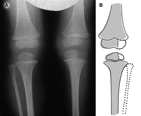 View of Lateral Epiphyseal Narrowings with Absent Fibula Conform to a ...