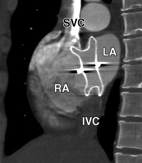 MDCT Evaluation After Closure of Atrial Septal Defect with an Amplatzer Septal Occluder | AJR