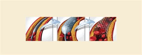 Angiogram vs Angiography vs Angioplasty: What's the Difference? – Knya