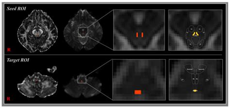 Three-Dimensional Identification of the Medial Longitudinal Fasciculus ...