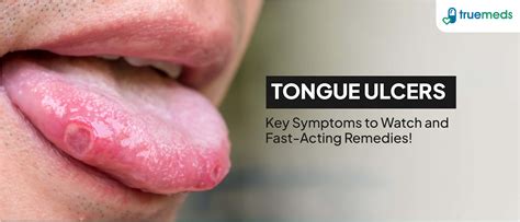 Canker Sore Tongue CANKER SORE Treatment And Mouth Ulcer Causes