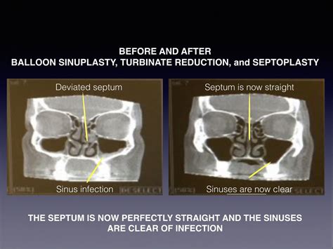 Face Before And After Sinus Surgery