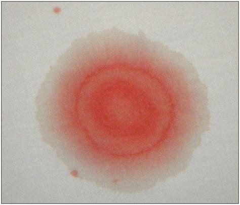 Basal skull fracture and the halo sign | CMAJ