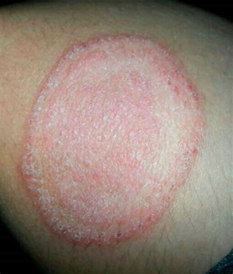 Tinea corporis causes, symptoms, diagnosis & treatment