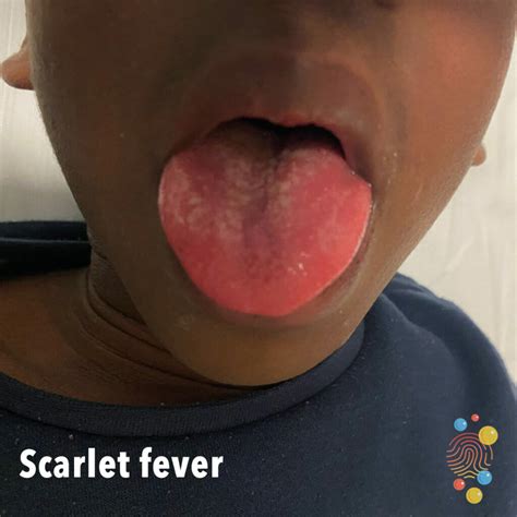 Scarlet Fever Scarlet Fever | DermNet NZ