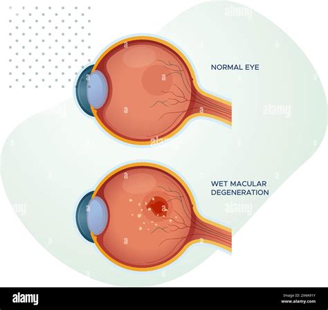 Healthy Eyes vs Wet Macular Degeneration - Stock Illustration as EPS 10 File Stock Vector Image ...