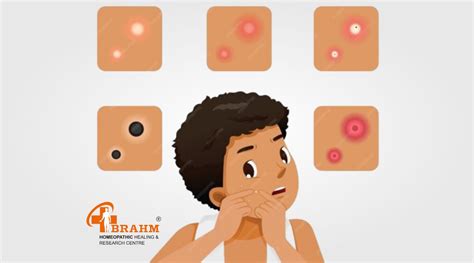 Warts | Warts treatment | Wart treatment in homeopathy | wart best doctor