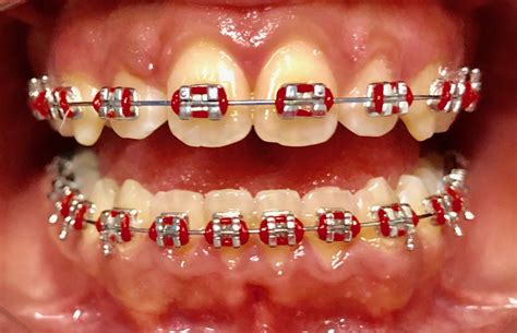 Pin by Mikayla;) on Ideas in 2025 | Dental braces colors, Braces colors ...