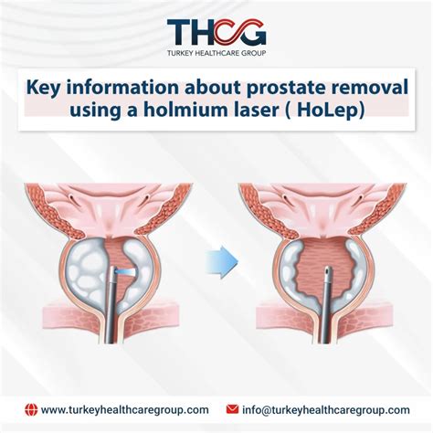 Key information about prostate removal using a holmium laser ( HoLep) 2025 - Turkey Health Care ...