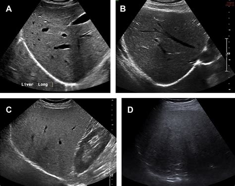 Ultrasound of Diffuse Liver Disease Including Elastography - Radiologic Clinics